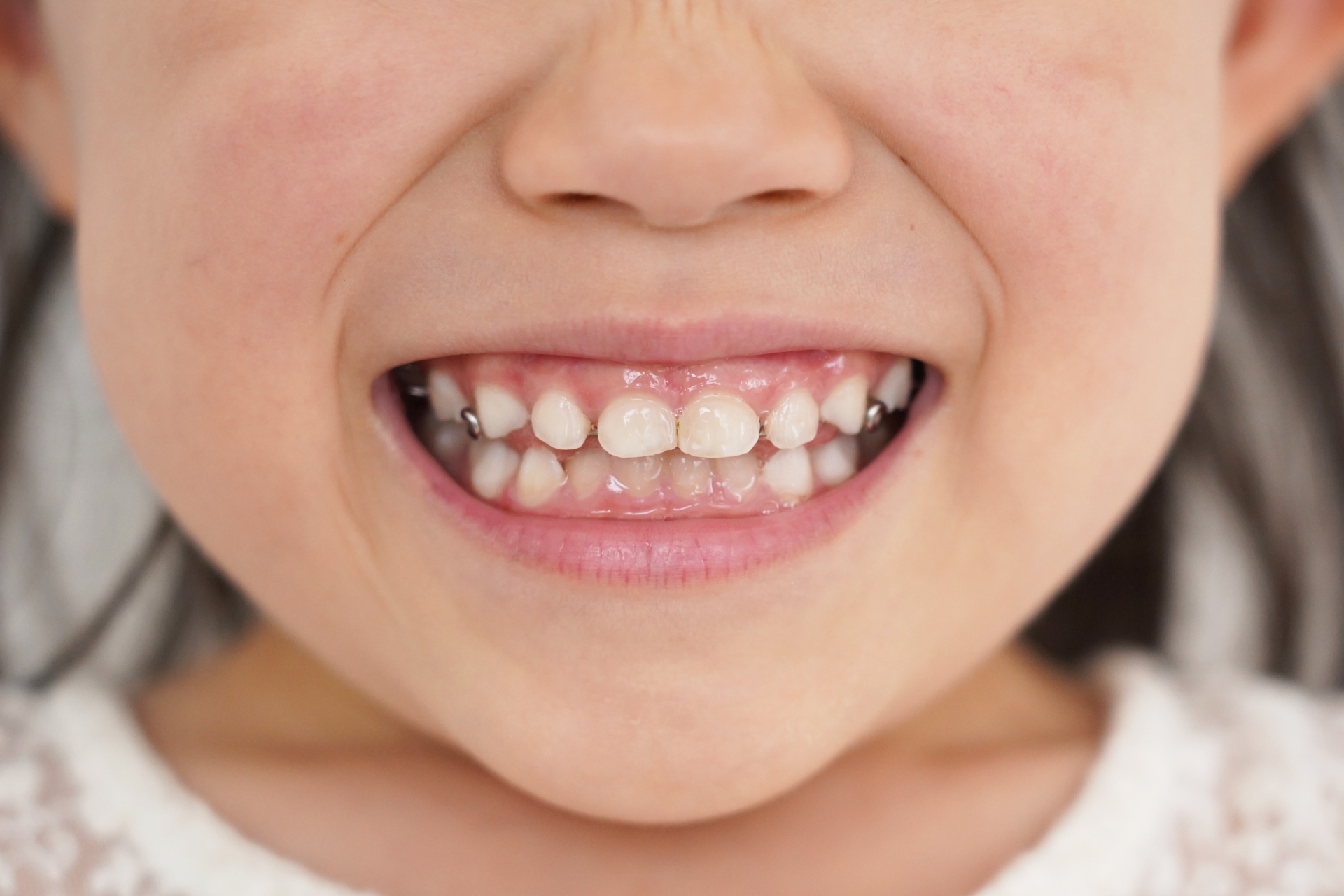 こどもの矯正はどのくらい期間がかかる？