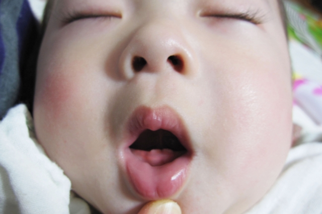 先天歯はどうすれば良いの？生まれた時から歯があるのは異常？